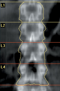 DEXA scan image