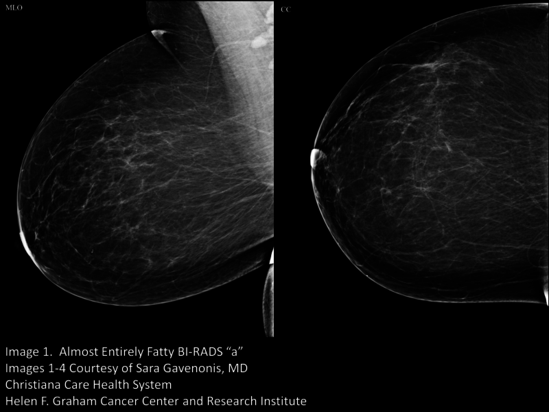 Your patient got a dense breast notification with her mammogram report ...