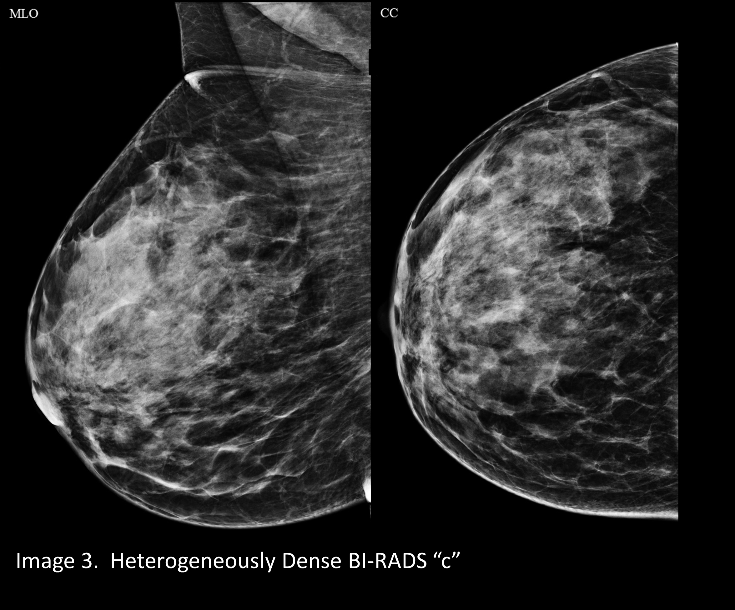 Your Patient Got A Dense Breast Notification With Her Mammogram Report What Are You Supposed To Do Christianacare News