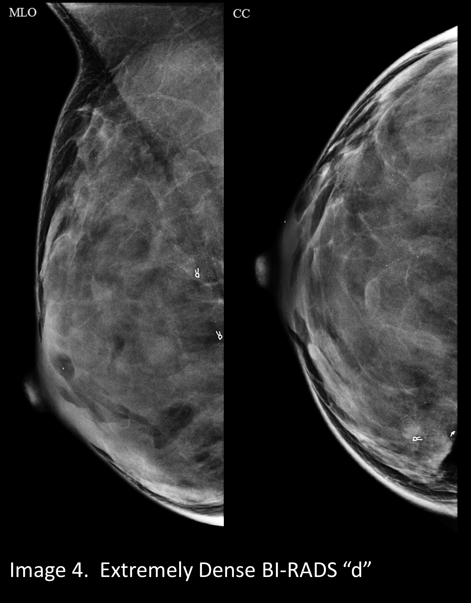 Your patient got a dense breast notification with her mammogram report:  What are you supposed to do? - ChristianaCare News