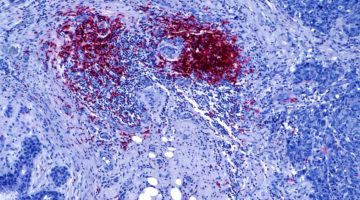 New Research: Tumor Cells Can Manipulate the Body’s Natural Antibody Response to Triple Negative Breast Cancer