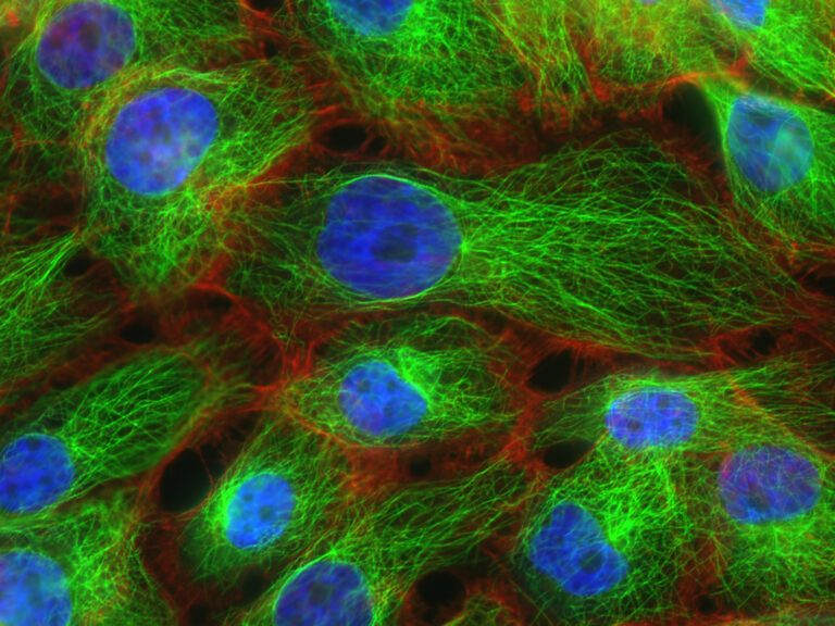 Why Breast Cancer Is Harder to Treat Than We Thought