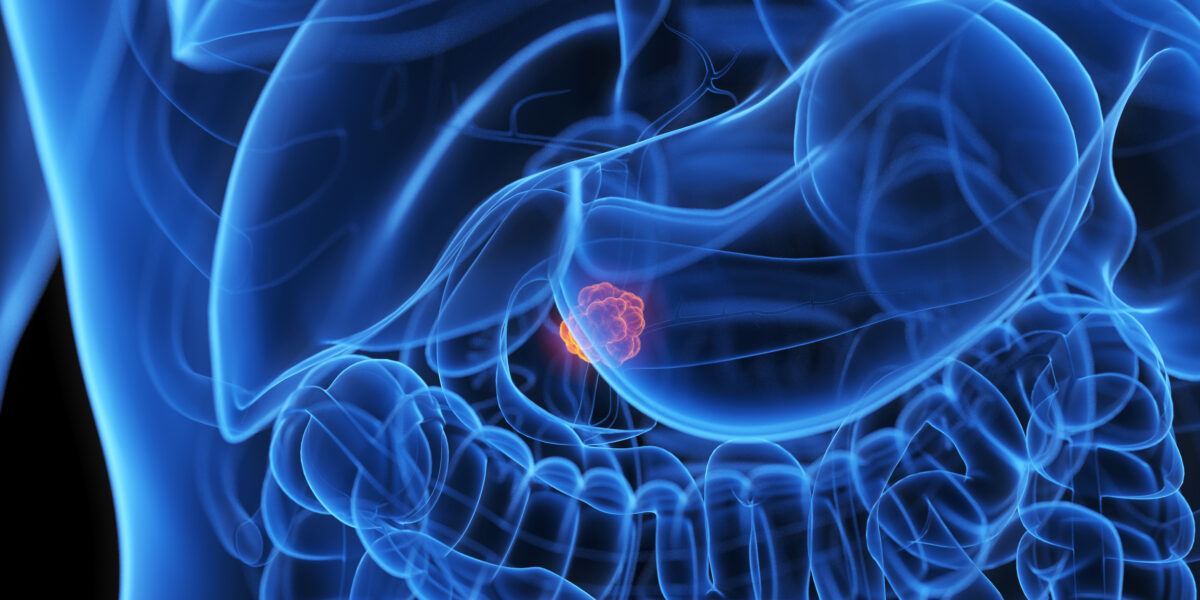 Lindsay Romak, M.D., Helps Shape National Guideline for Pancreatic Cancer Treatment