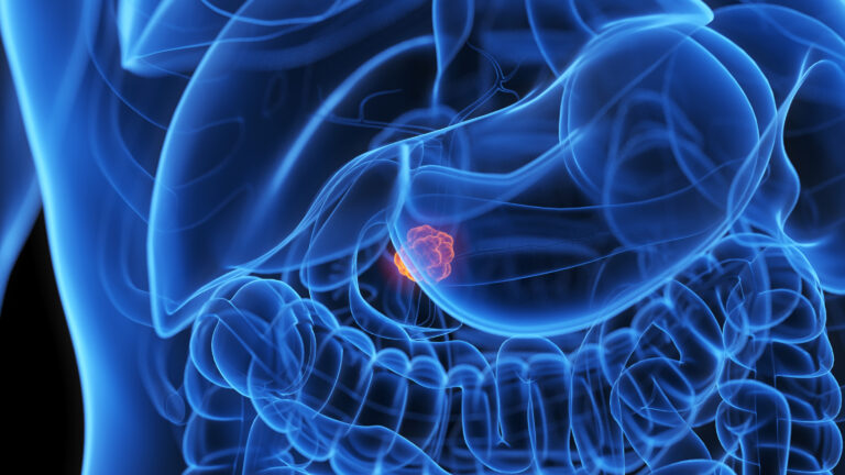 Lindsay Romak, M.D., Helps Shape National Guideline for Pancreatic Cancer Treatment